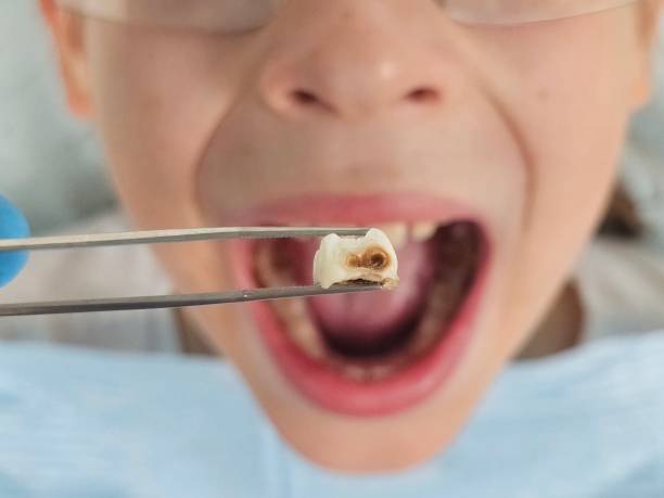 Best Emergency Dental Extractions in Benton, LA